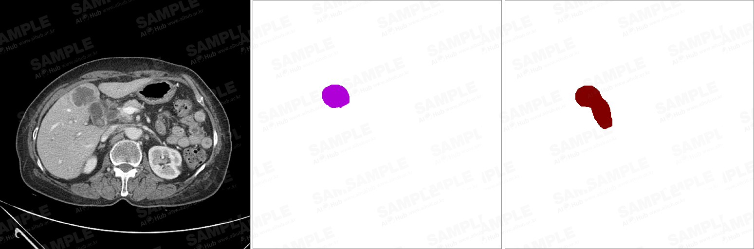담낭암 진단 의료 영상-대표도면-좌측: dcm파일 중앙및 우측: png 파일-병변 및 장기 라벨링