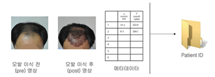 모발이식 및 두피확대 이미지-모발이식수술전후 영상 포맷-데이터 구성