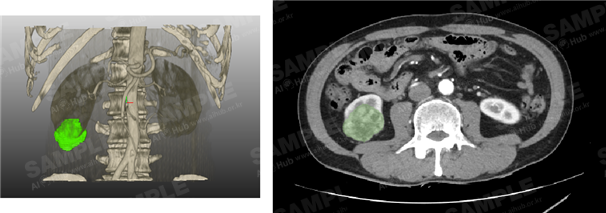 신장암 진단 의료 영상-신장암 환자 CT영상과 레이블링 겨로가(연두색) 예시