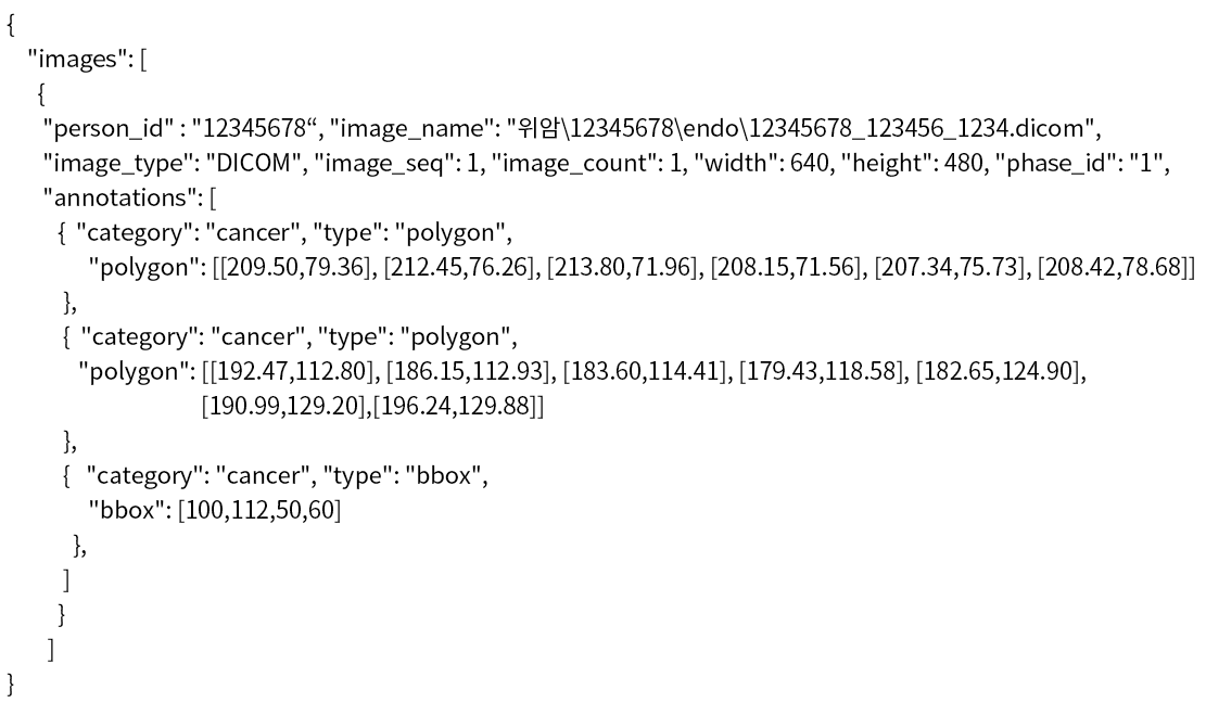 위암 진단 의료 영상-어노테이션 포맷-Json 파일 샘플