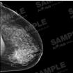 유방암 진단 의료 영상-대표도면_2_유방암 영상데이터(유방촬영술)