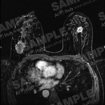 유방암 진단 의료 영상-대표도면_3_유방암 영상데이터(유방MRI)