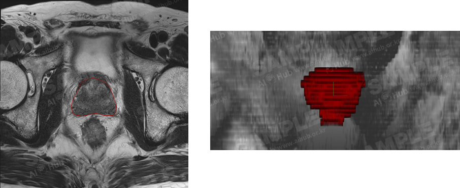 전립선암 진단 의료 영상-대표도면 예시-전립선암 환자 MRI 영상과 전립선 영역 레이블링 결과 (우측 빠간영역) 예시