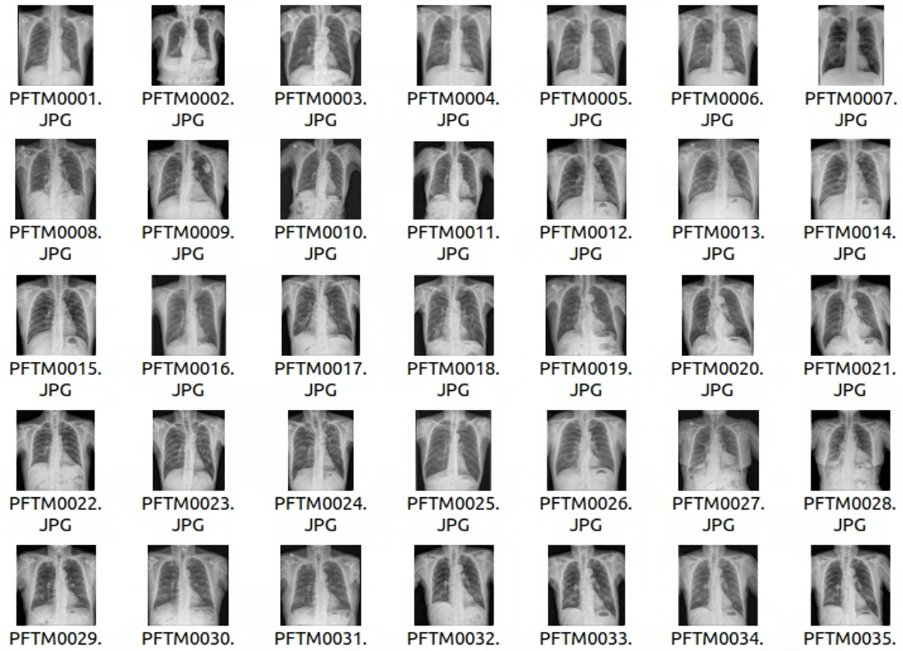 만성 폐질환 흉부 엑스레이 가공 이미지 예시